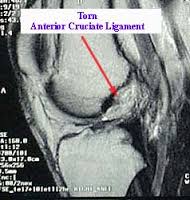 mri